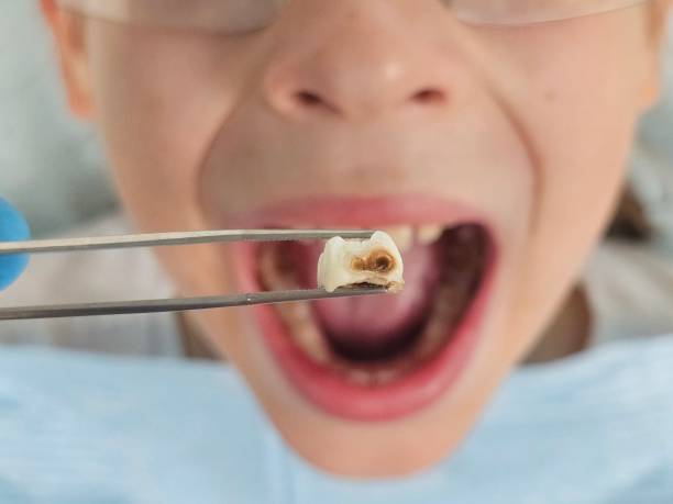 Best Broken or Chipped Tooth Repair in Orange Cove, CA